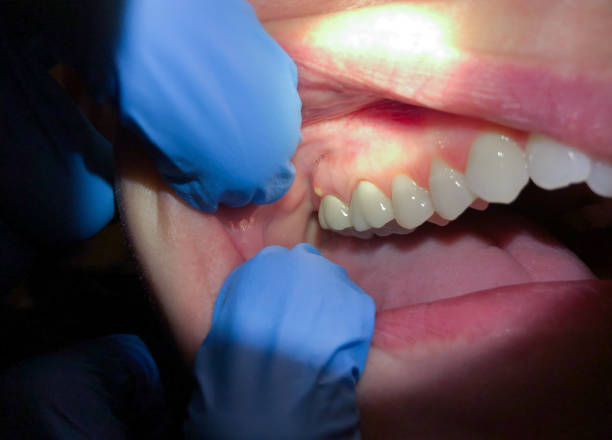 Best Tooth Infection Emergency Dentist  in Vineland, NJ